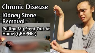 PULLING OUT MY OWN STENT  Kidney Stone Removal amp Recovery Graphic [upl. by Irrok99]