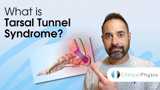 Tarsal Tunnel Syndrome  Expert Physio Guide [upl. by Novonod]