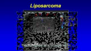 Ultrasonography of Superficial Soft Tissue Masses [upl. by Trinatte69]