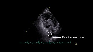 Stroke From Paradoxical Embolism Through a Patent Foramen Ovale [upl. by Ainsworth612]