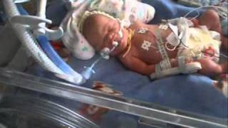 Premature baby born at 30 weeks [upl. by Katherina]