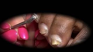 Ingrown Toenails Treatment Satisfying Pedicure Manicure 15 [upl. by Oniliuqnart]