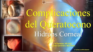 Hidrops Corneal Complicaciones del Queratocono [upl. by Hewart]