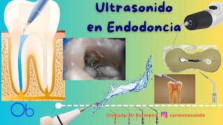 Ultrasonido en Endodoncia [upl. by Jennine16]