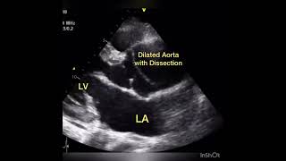 Type A Aortic Dissection on Ultrasound AorticDissection cardio cardiology [upl. by Thomsen202]