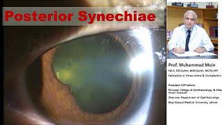 Post Synechiae in Uveitis [upl. by Casaleggio]