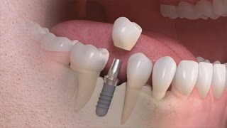 Straumann  Trattamento singolo dente su impianto [upl. by Ettenav]