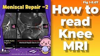 Fig 1E07 Expected appearance of meniscal repair 2 [upl. by Reave]