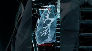 Expiratory Wheezing is an abnormal lungs sound adventitious sound shorts [upl. by Ahsiemaj]