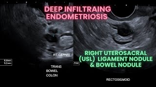 Ultrasound Deep infiltrating endometriosis Bowel nodule and uterosacral ligament nodule [upl. by Valentino]