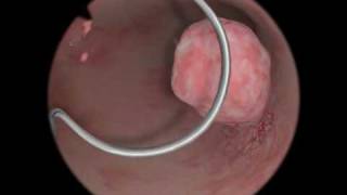 Polypectomy  Polyp Removal  Virtual Reality Simulation for Endoscopic Surgery [upl. by Banna534]