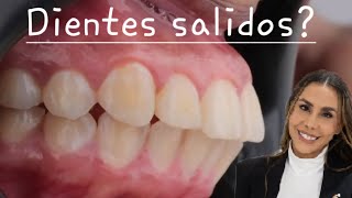 Tienes los dientes salidos revisemos este caso [upl. by Bartram]