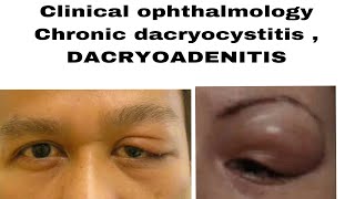 Clinical ophthalmology chronic dacryocystitis DACRYOADENITIS acute and chronic in easiest way [upl. by Akehs]