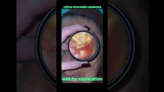 Retinochoroidal coloboma shorts opthalmology neetpg [upl. by Atyekram61]