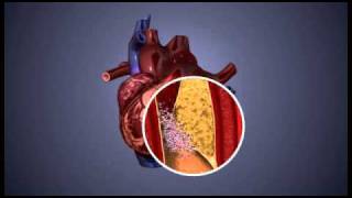 Atherosclerosis  3D Animation  ABP © [upl. by Lyon]