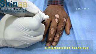 Vitiligo or Leucoderma Treatment Micropigmentation in India  Safed Daag Ka Ilaj │Skinaa Clinic [upl. by Edgard]