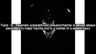 Traumatic pneumorrhachis Top 10 Facts [upl. by Julianna]