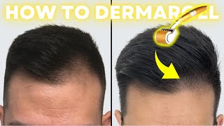 How to Derma Roll for Quickest Hair Results StepbyStep Guide [upl. by Uella338]