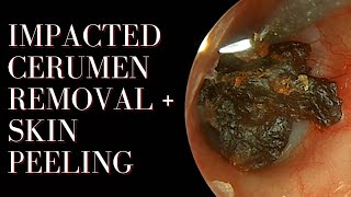 Impacted Cerumen Removal  Skin Peeling [upl. by Toor461]