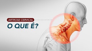 Artrose da coluna cervical  O que é e como fazemos o diagnóstico [upl. by Lyssa]