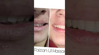 Ceramic braces minimal Treatment big change viralbraces orthodontist smile shorts [upl. by Atekan]