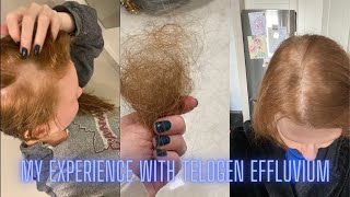 My Experience with Telogen Effluvium [upl. by Eusebio]