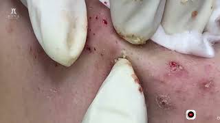 Big Cystic Acne Blackheads Extraction Blackheads amp Milia Whiteheads Removal Pimple Popping [upl. by Ytsrik]