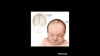 Clinical significance of fontanel [upl. by Nanreik]