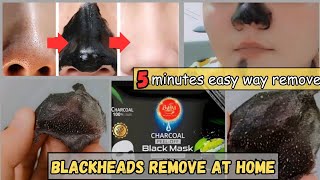 Blackheads remove at home  whiteheads removal at home [upl. by Arad]