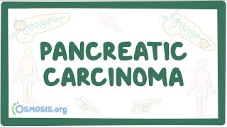 Pancreatic carcinoma  an Osmosis Preview [upl. by Aikyt]