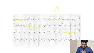 MASTERING ECGLESSON15 RIGHT BUNDLE BRANCH BLOCK RBBB [upl. by Reagen]