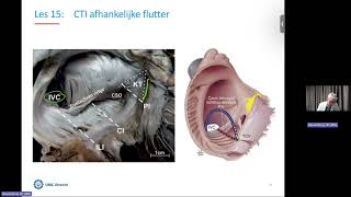 Online EP Les 15 RA isthmus afhankelijke flutter [upl. by Esch]