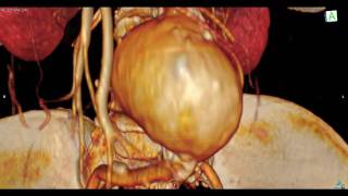 Abdominal Aortic Aneurysm ： 大動脈瘤内視鏡 [upl. by Boles355]