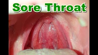 Normal vs Sore Throat  Pharyngitis [upl. by Gnok]