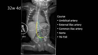 Umbilical Arterial Catheters UACs  Pediatric Radiology and NICU [upl. by Purcell683]