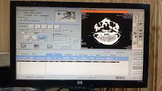 Extensive SAH with intraventricular extension  ct scan brain plain  LOC [upl. by Rehteh491]