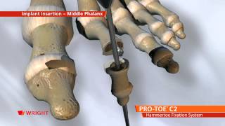 PROTOE™ C2 Hammertoe Fixation System Animation [upl. by Naehs]