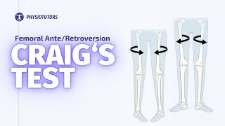 Craigs Test  Femoral Anteversion [upl. by Beatrix689]