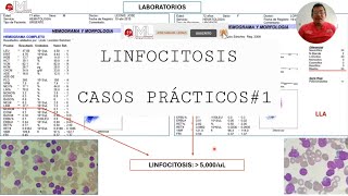 LINFOCITOSIS CASO CLÍNICO DE LLC VS LLA [upl. by Oisangi]