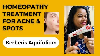 Berberis Aquifolium Gel for Acne amp Scars  Homeopathy Treatment for pimples [upl. by Renelle]