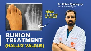 Bunion Treatment in Hindi  गोखरू Hallux Valgus का इलाज कैसे करें  Dr Rahul Upadhyay [upl. by Atyekram]