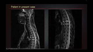 Sports Medicine Case 50 15yearold male Interesting Mechanism Leads to Uncommon Thoracic Injury [upl. by Rene]