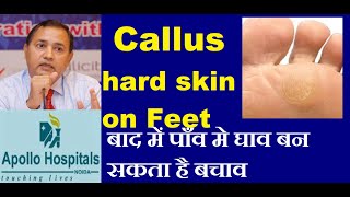 Callus Callosity Hard Skin on Feet in Diabetes lead to Diabetic Foot Ulcer Cause Treatment Prevent [upl. by Isleen]