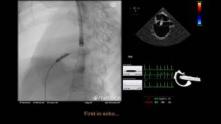 Atrial Septal Defect and Patent Foramen Ovale Occlusion ASD PFO [upl. by Noreen]