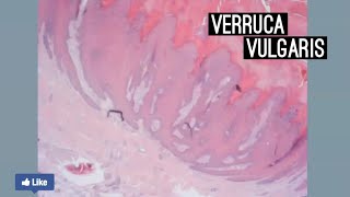 Verruca Vulgaris [upl. by Aicinat]