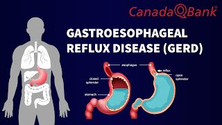 Gastroesophageal Reflux Disease GERD [upl. by Yeleen]