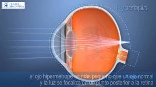 Hipermetropía  OptiLASIK cirugía refractiva 100 láser [upl. by Nove]