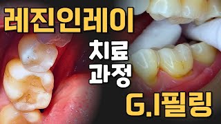 레진인레이와 GI필링 치료 진행합니다 [upl. by Norven]