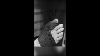 Arthrtitic bump removed in under 15 minutes arthriticbump podiatrist [upl. by Amorete182]