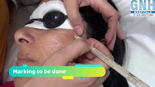 Treatment of Melasma amp Hyperpigmentation at GNH Hospital Gurgaon [upl. by Asim470]